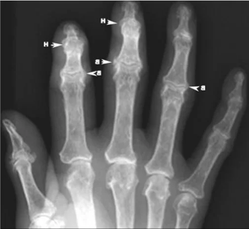 Osteophytes in arthrosis of finger joints on X-ray