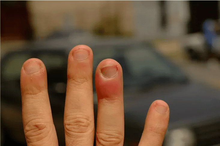 Periungual panaritium causing pain in the joints of the fingers