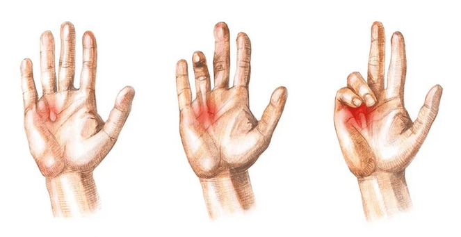 Stages of Dupuytren's contracture - inability to straighten fingers