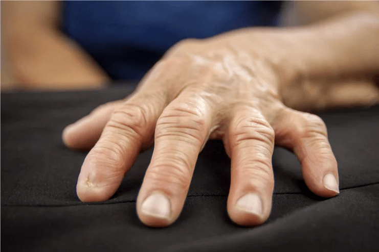 With gout, the joints of the fingers become hot, swollen and painful to the touch. 