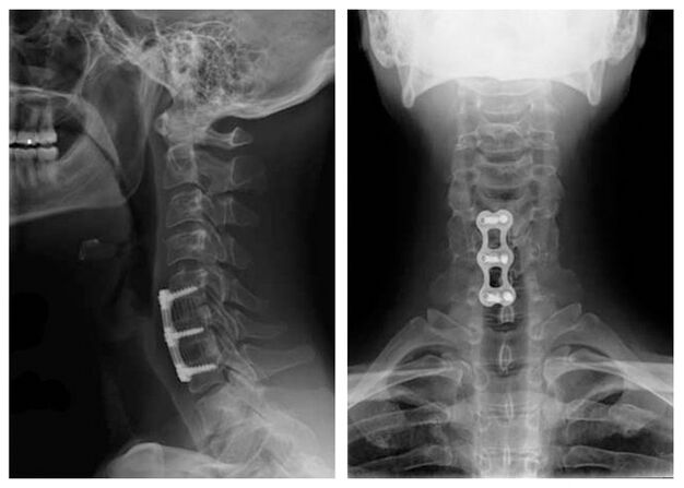 Picture after vertebree treatment
