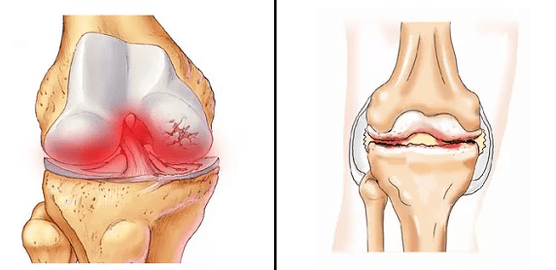 A comparison of arthritis arthrosis