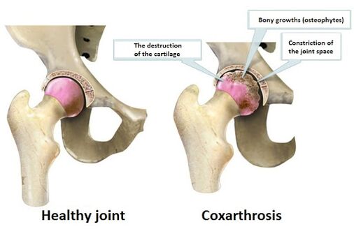 A healthy combination affected by the union of coxery