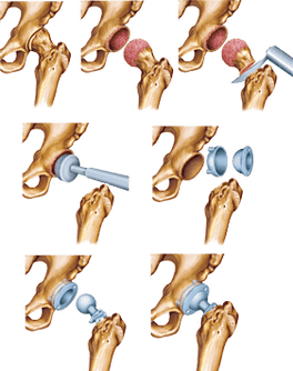 Installation of an endoprosts