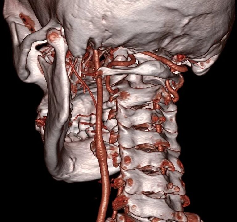 squeeze the artery with cervical osteochondrosis