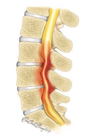 Compression of the spinal canal occurs with osteochondrosis of the thoracic spine