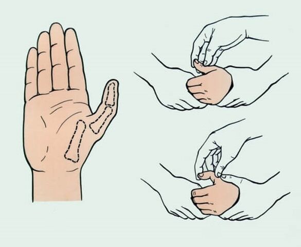 Reduction of the displaced finger needed to relieve joint pain