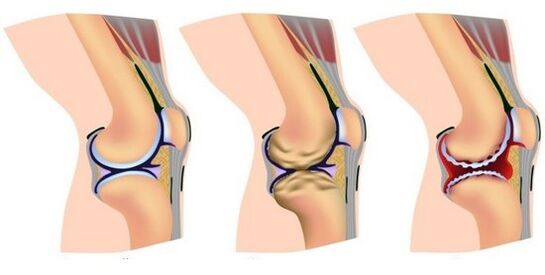 pain due to the destruction of a healthy joint and knee joint