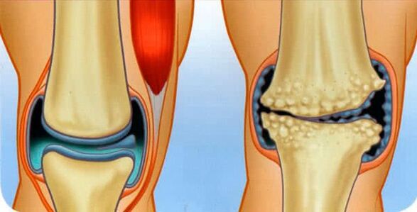 healthy joints and arthrosis of the joint