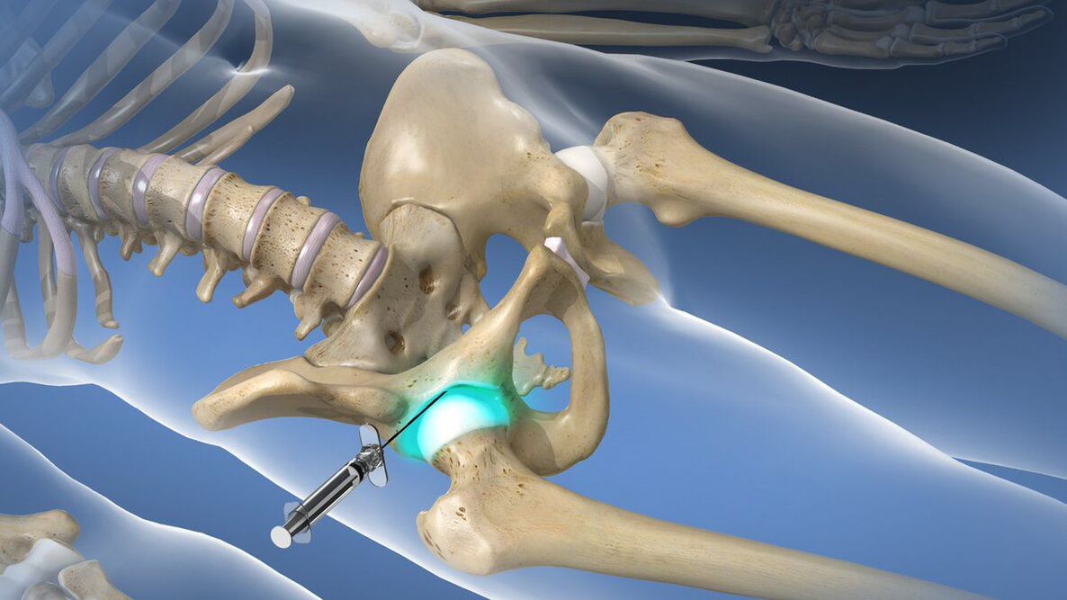 Intraarticular block for severe pain accompanied by hip arthrosis