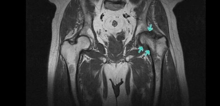 Osteoarthritis of the femoral joint on MRI