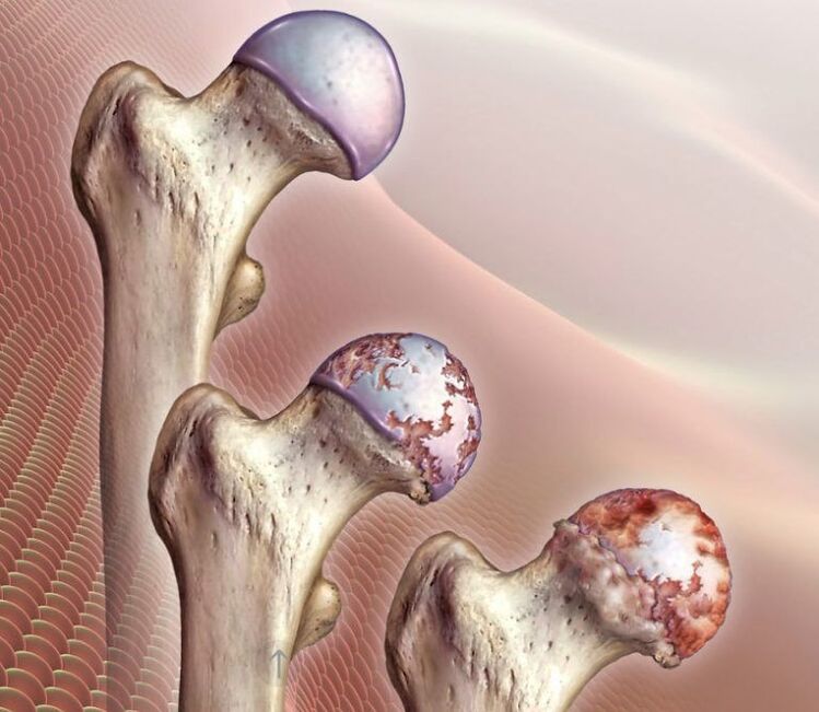 Osteoarthritis of the hip joint of various degrees