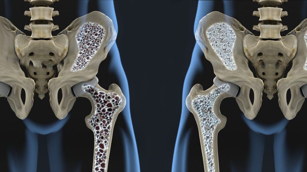 Osteoporosis is the cause of hip fractures and hip arthrosis