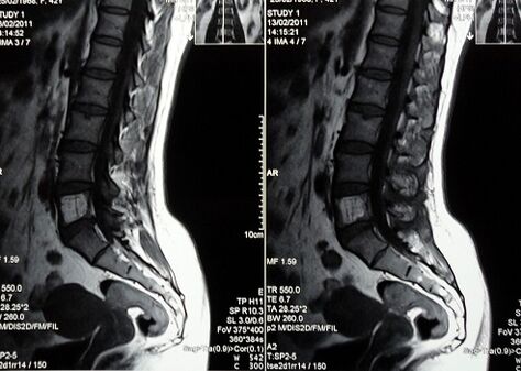 MRI of the lumbosacral spine for the diagnosis of low back pain