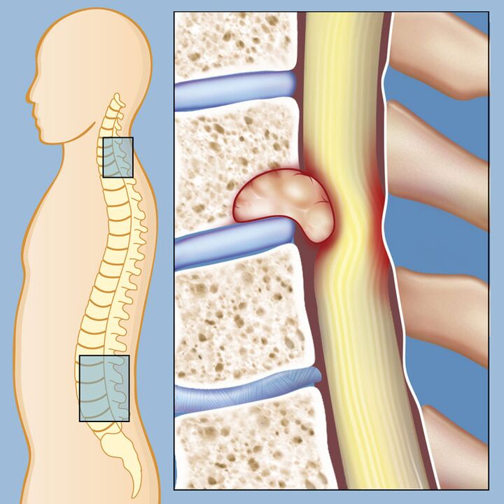 Malignant tumor as a cause of severe back pain